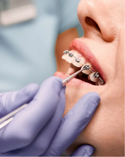 Orthodontic Treatment